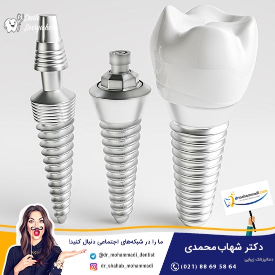 قیمت انواع ایمپلنت های خارجی در قیمت انواع ایمپلنت های خارجی در تهران - کلینیک دندانپزشکی دکتر شهاب محمدی
